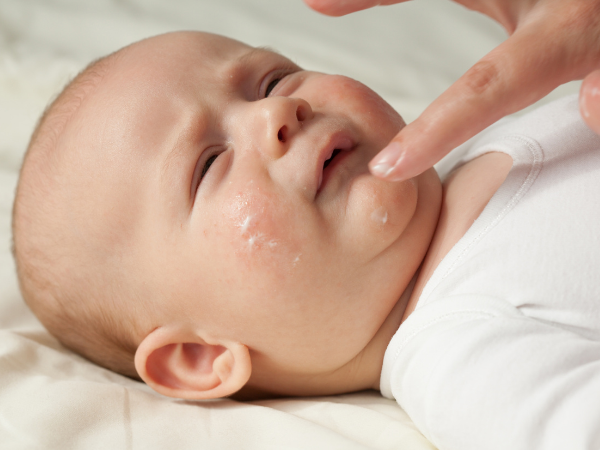 La dermatite atopique : comment soulager son bébé ?